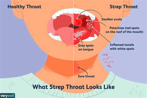 strep throat pain