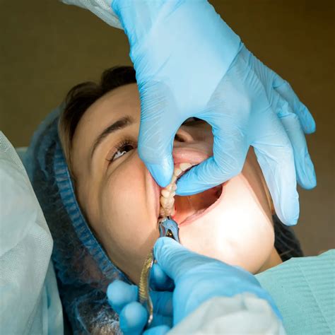 After Molar Extraction Care: Recovery | Dentist In Preston