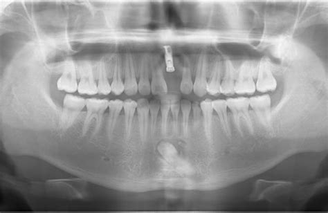 单颗牙种植成功案例(图片),种植牙,单颗牙种植,种植牙,牙科网www.yadashi.com