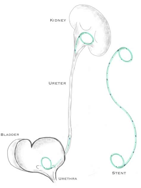 Explainer: What is a Ureteric Stent? – Dan Lenaghan (03) 9974 6200