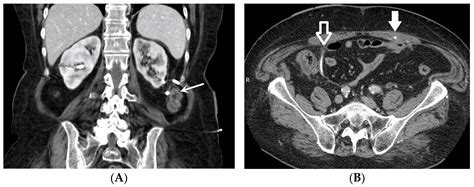 Complications Subsequent to Urinary Tract Stent Placement: An Overview Focusing on the Imaging ...