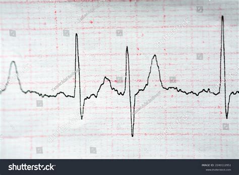 Ecg Electrocardiograph Paper That Shows Normal Stock Photo 2240112951 ...