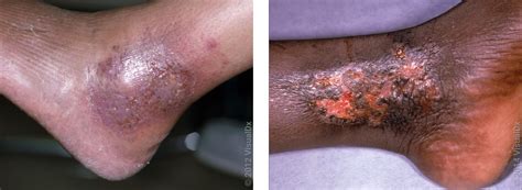 Stasis Dermatitis: Pictures, Causes, and Treatment - GoodRx