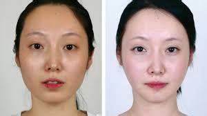 What is V-Line Jaw Surgery? Everything You Need to Know.