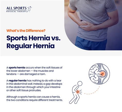7 Ways to Treat a Sports Hernia