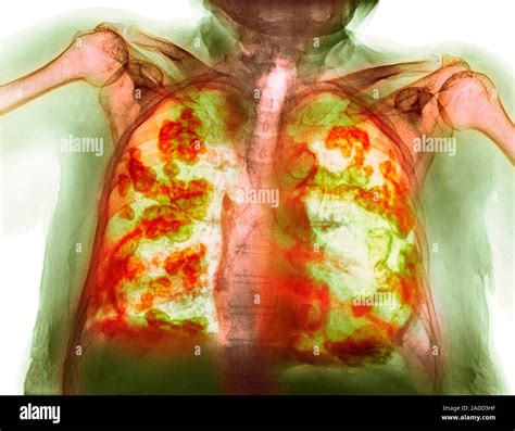 Bilateral pleural calcification, coloured X-ray. The pleura are the ...