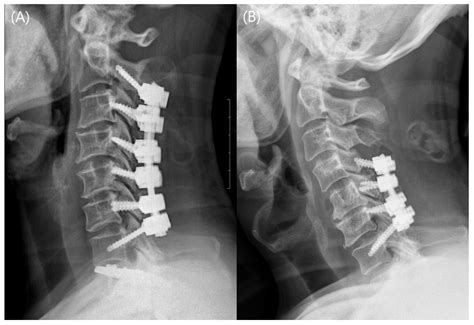 Mechanical Stability and Clinical Outcomes Following Posterior Cervical ...