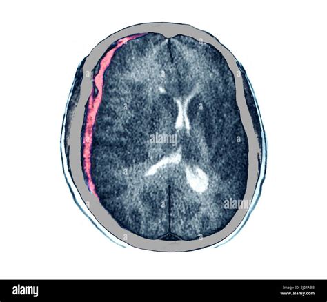 Subdural Haematoma Ct Scan