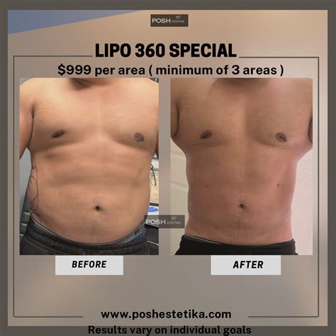 Liposuction 360 - Posh Estetika