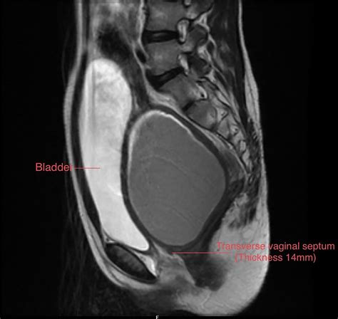High imperforate transverse vaginal septum with vaginal cicatrisation: a surgical tribulation ...