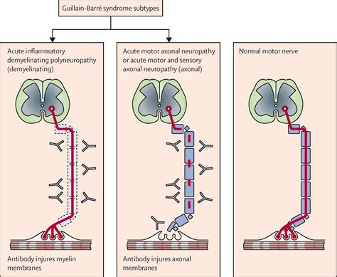 Guillainbarre Syndrome Life Expectancy
