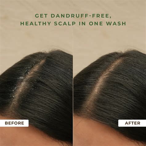Naturali Anti-Dandruff Shampoo +Anti-Dandruff Scalp Serum + Scalp Mass