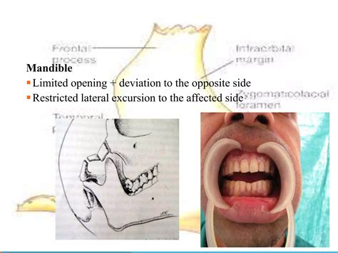 Management of zygomaticomaxillary complex fractures ih | PPTX