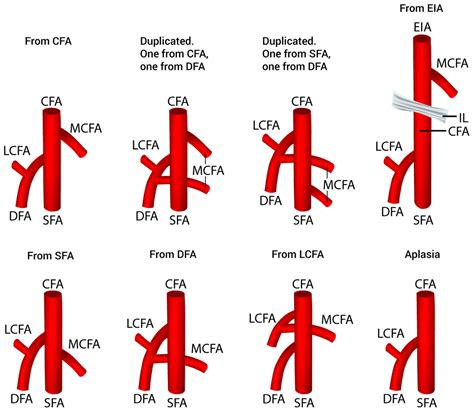 The origin of the medial circumflex femoral artery: a meta-analysis and ...