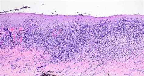 Oral Lichen Planus Histology
