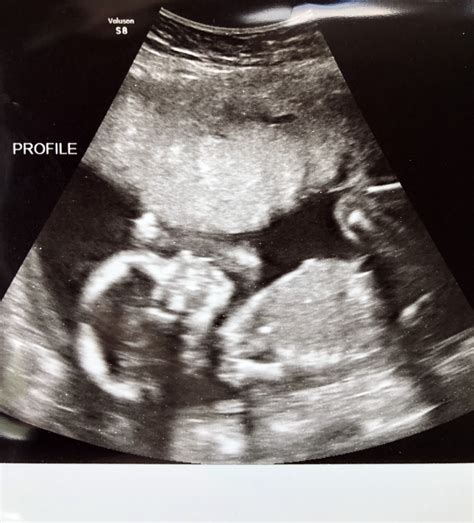 Baby Profile Ultrasound