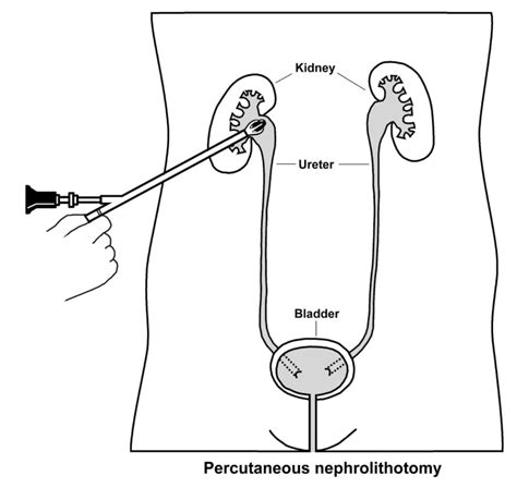 Percutaneous nephrolithotomy (PCNL) — Urology Associates