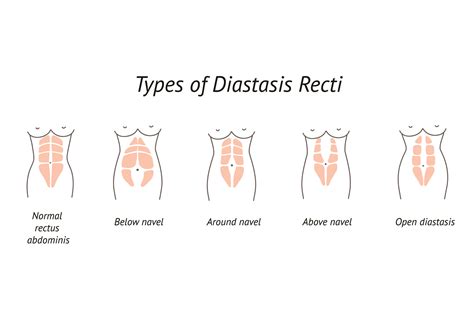 Learn More About Diastasis Recti – Abdominal Muscle Separation During Pregnancy - Carriwell