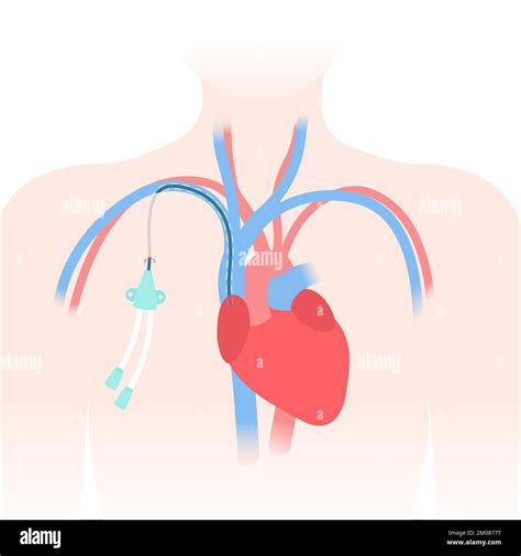 Tunneled central venous catheter placed in the subclavian vein. Patient with CVC long term ...