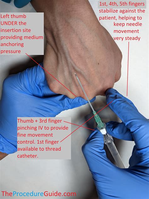 Intravenous Catheter Insertion