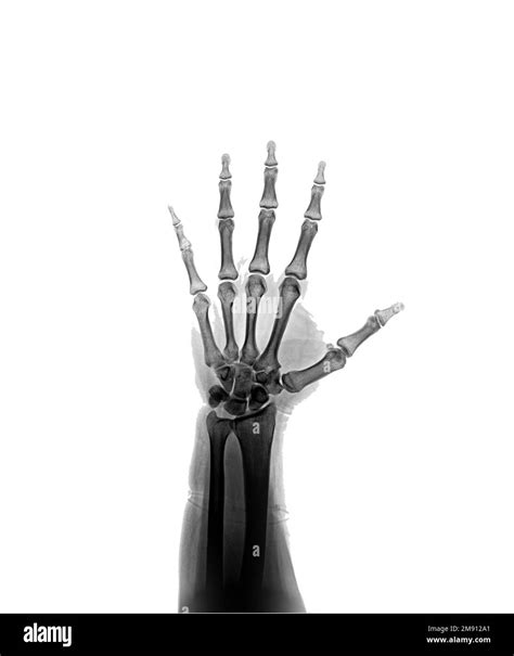 X-ray hand AP view normal Stock Photo - Alamy