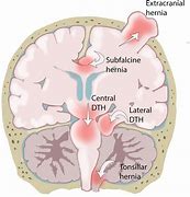 Image result for herniation