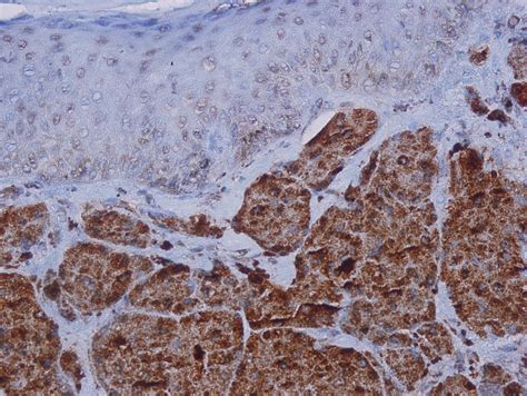 Pathology Outlines - Granular cell tumor
