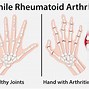 Image result for Childhood Rheumatoid Arthritis