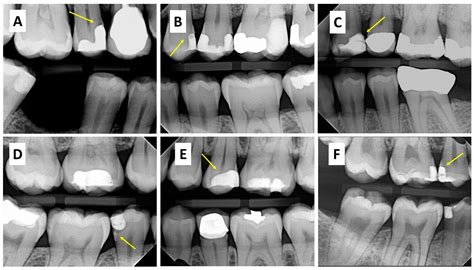 Prevalence and Characteristics of Radiographic Radiolucencies ...