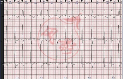 心电图图例分析：心房颤动伴完全性右束支阻滞，室性早搏 - 爱爱医医学网