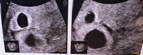 Embarazo gemelar!!! 6 semanas y 6 días | BabyCenter