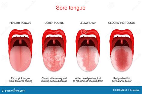 Erosive Lichen Planus