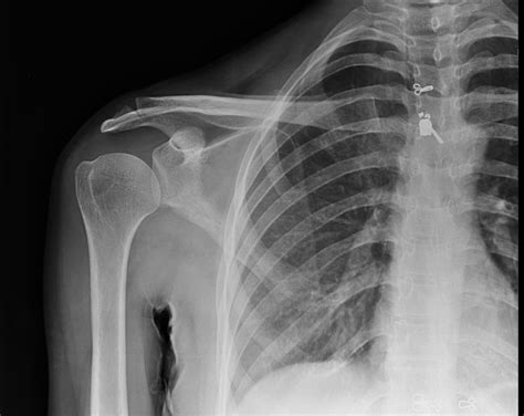 Ac Joint Fracture X Ray at Christopher Doyle blog
