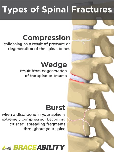 Difference Between Wedge, Compression, & Burst Spinal Fractures Fracture Symptoms, Bone Fracture ...