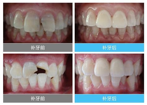 牙体预备全过程（原创）-周洋的博客-KQ88口腔博客