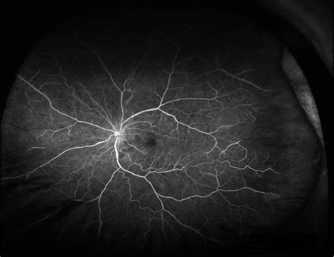 lupus vasculitis