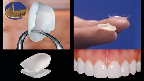 Veneers Process And What To Expect