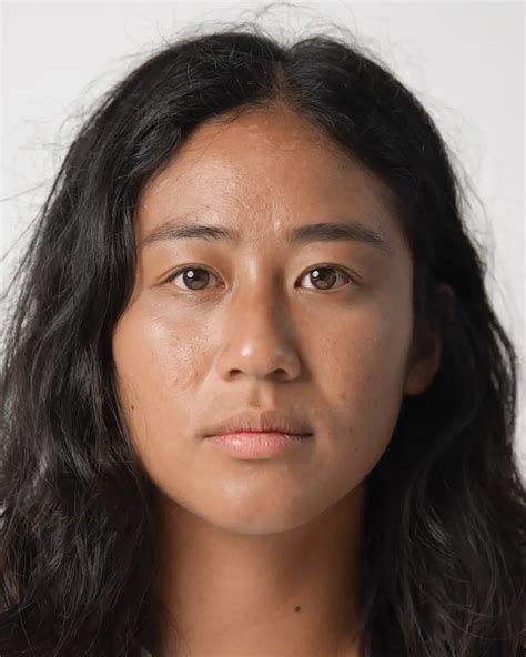 Enlarged Pores Treatment - Microneedling for Large Pores