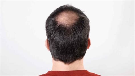 Does Wearing A Hat Cause Hair Loss - Scalp Designs - Scalp Micropigmentation Boston