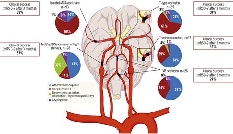 Middle Cerebral Artery Occlusion
