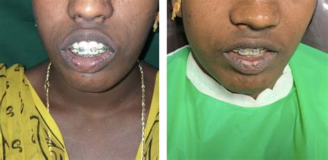 Best Jaw Surgery Hospital & Surgeon for Jaw Implant in India | Edensdental