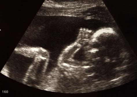 Ultrasound 的图像结果