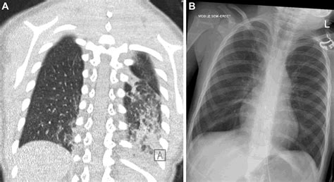 Chest X Ray Vs Ct Scan Pneumonia at Frederick Rosado blog