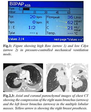 Pulmonary Dynamics in a Ventilated Breast Cancer Patient