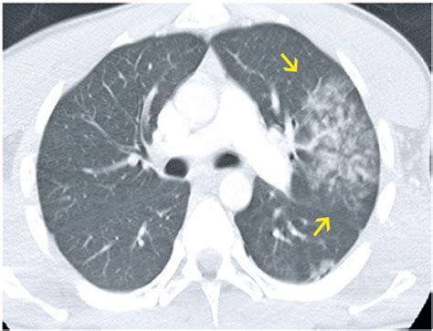 Ground Glass Opacity In Lungs