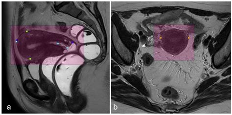 Three-Dimensional Measurement of the Uterus on Magnetic Resonance Images: Development and ...