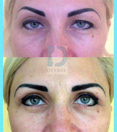 Laser Blepharoplasty Before And After (1) » Eyelid Surgery: Cost, Photos, Rewiews, Q&A