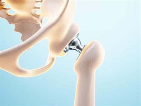 Metal Allergy After Joint Replacement Surgery: Causes, Symptoms And ...