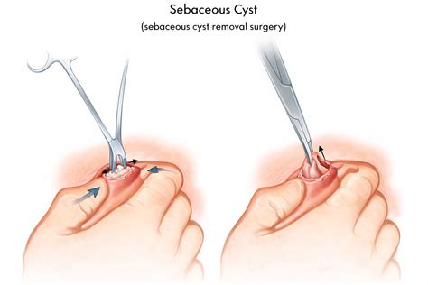 Popping a Sebaceous Cyst - Can I Burst a Sebaceous Cyst at Home? - Aventus Clinic