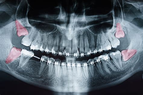 Why Are Wisdom Teeth Called Wisdom Teeth?